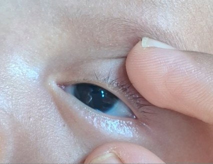 Pupil putih keabuan