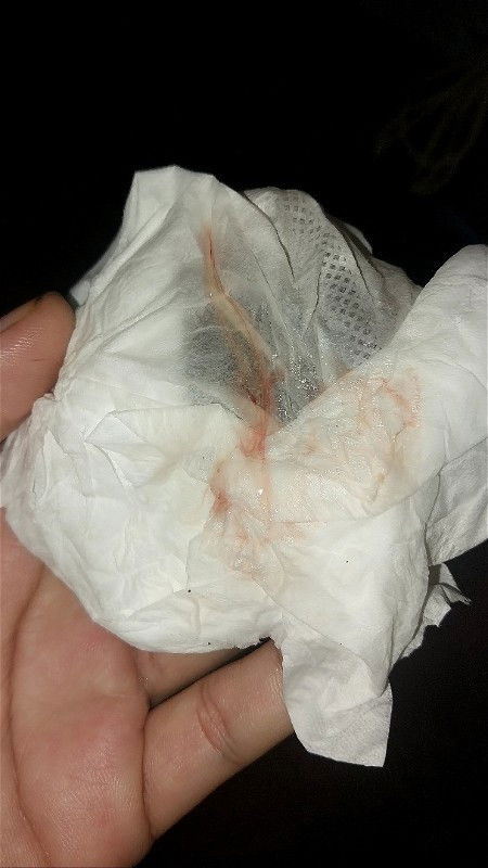 Ketuban rembes UK 36+5, keluar lendir & darah tapi gak kontraksi