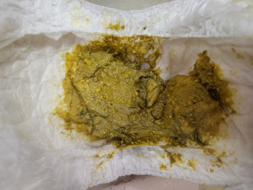 อยากถามแม่ๆบ้านไหนลูกถ่ายเป็นสีนี้บ้างคะแล้วถ่ายสีนี้ปกติไหมคะ