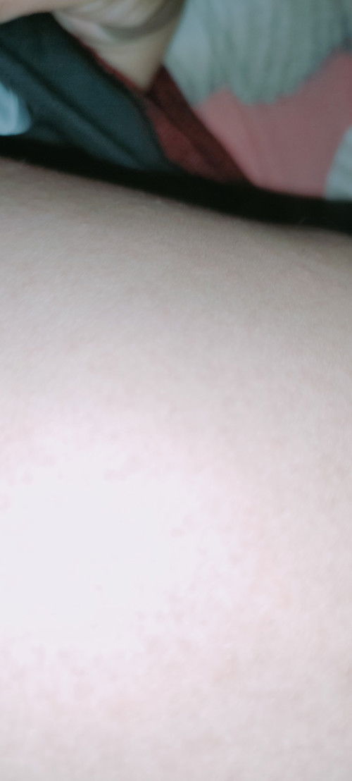 Rashes sa katawan ni baby.