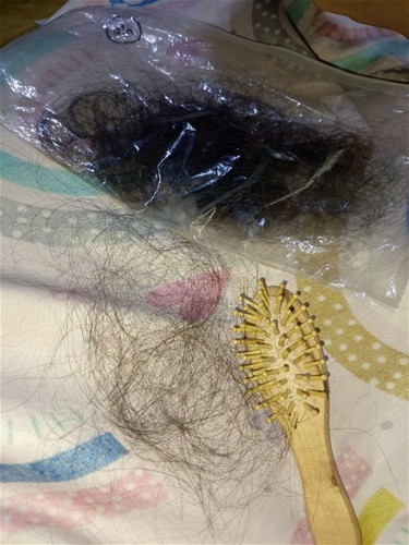 Postpartum hair loss.
