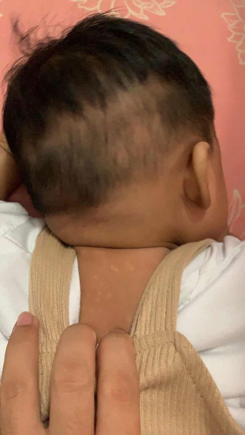 Putih putih dikulit bayi