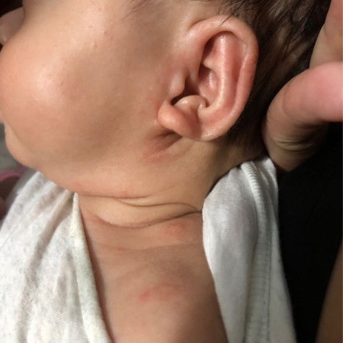 Các mẹ ơi con e 1m14d bị nỗi nhiều mụn như này quanh người