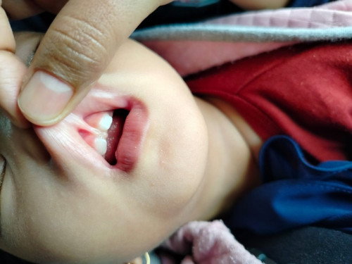 Mulut dan gusi menyatu