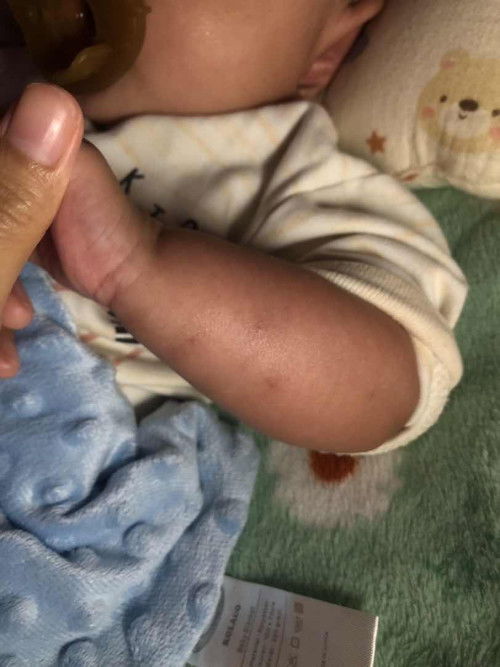 แก้รอยดำยุงกัดมดกัด