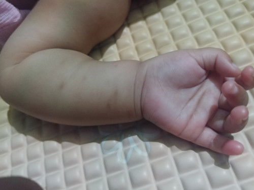 Krim bayi untuk menghilangkan bekas gigitan nyamuk