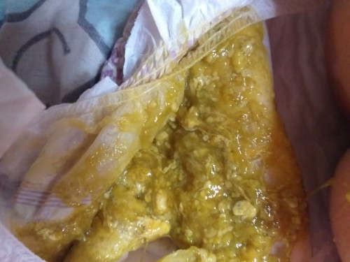 Normal lang po ba ang ganitong color ng poop? 7 months old po.