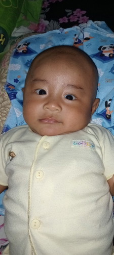 Bun mata anak saya kok agak juling seperti ini, kirakira normal ga ya bun?