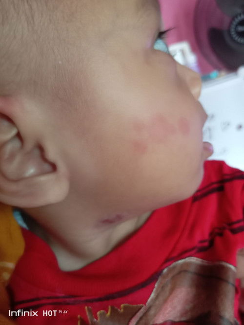 Bercak merah di wajah bayi
