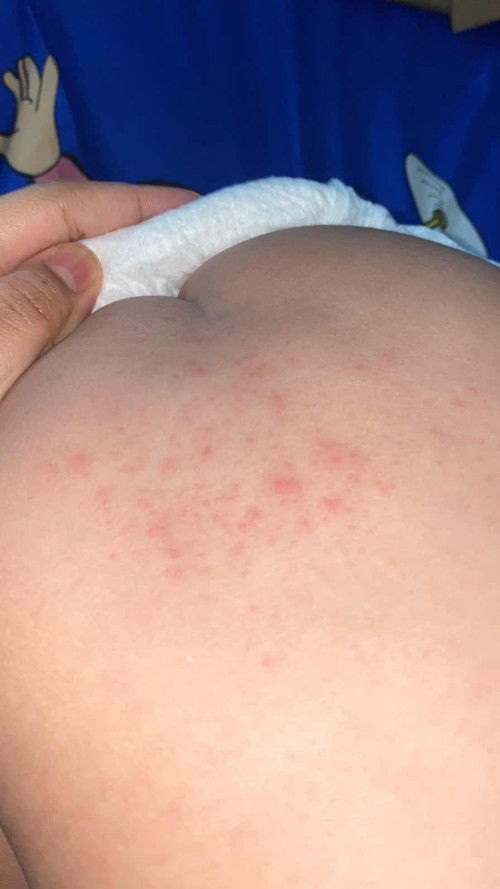 Obat alergi anak 1 tahun