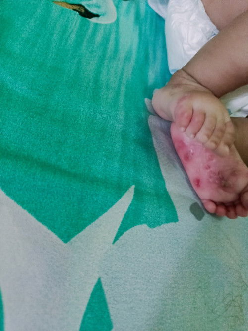 Bunda2 apakah ada yg sama punya sikecil Bru umur 2 bln tp kakinya sakit kyk gini udh di bawa ke dktr