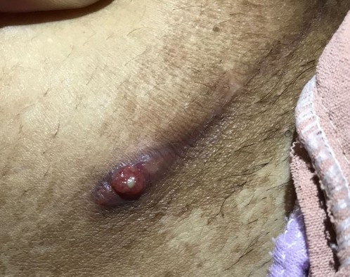 Muncul luka 50 hari setelah sc