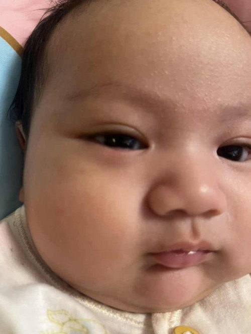 น้องใต้ตาแดงเหมือนตากุ้งยิง