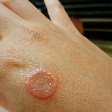 Obat jamur gatal sperti ini obatnya apa ya bund bingung bnget