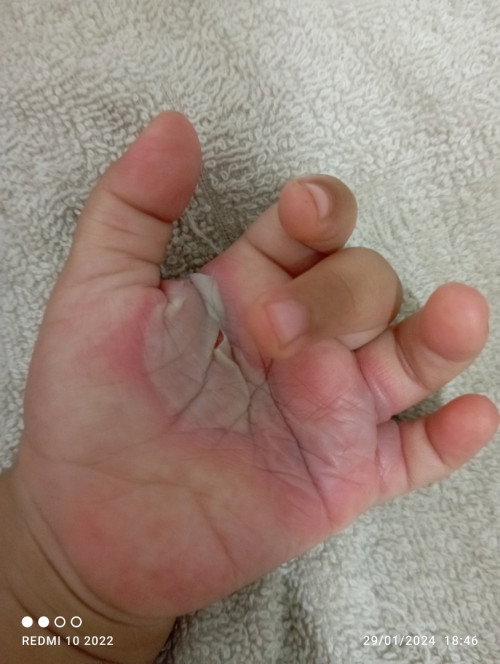 Telapak tangan melepuh kena lubang uap magicom