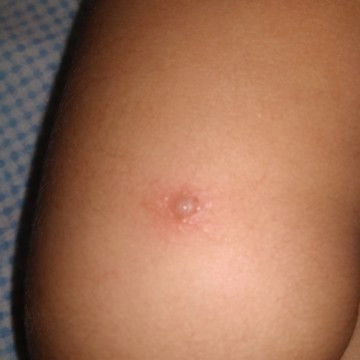 Obat gatal yang ampuh