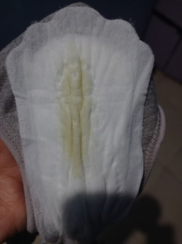 Maaf bund, kalau jijik liatnya. Saya tiap hari keputihan seperti itu normal gak ya?