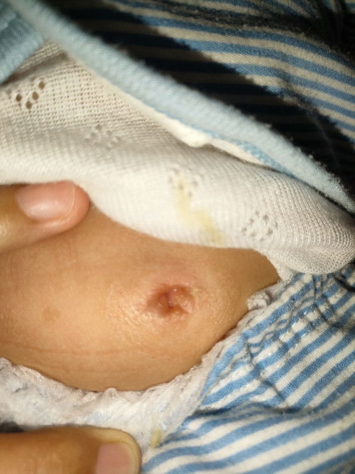 udel bayi, dan ruam popok