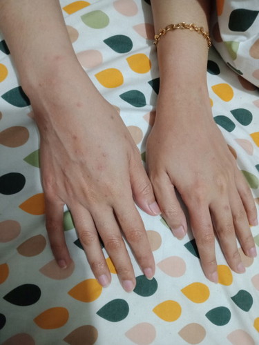 Hamil anak pertama -+10 Minggu area tangan (jari-pergelangan) gatal-gatal mau minum obat takut
