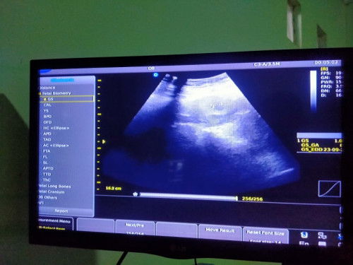 Usg kehamilan
