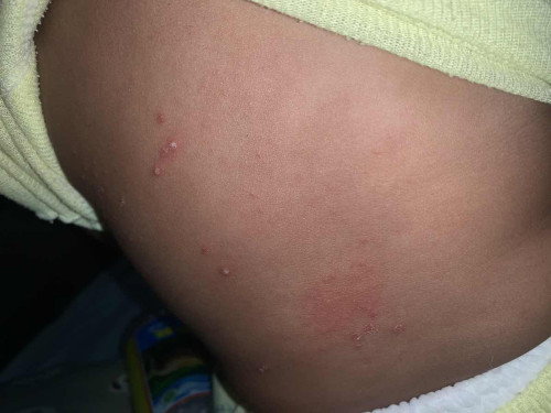 Bintik” pada kulit bayi