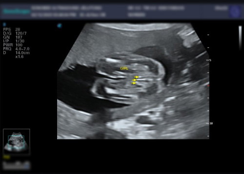 Confirm ke girl..scan KK masih tak nmpak...detail.scan katanya girl...anak first boy..😇