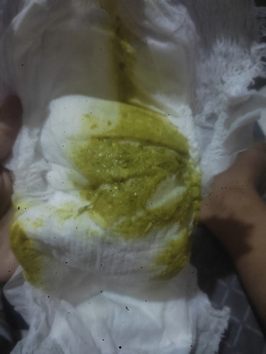 bun anak saya pup seperti ini sehari bisa sampai 3-4kali.ini kenapa ya? Terimakasih