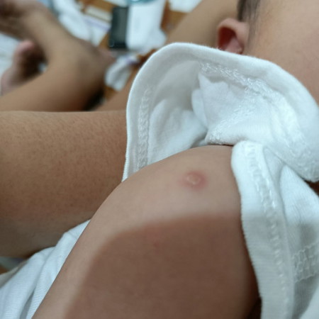 Normal lang ba na ganto ang itsura ng turok ni baby?
