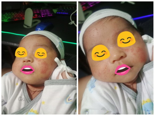 Mga butlig.butlig sa mukha at liig n baby