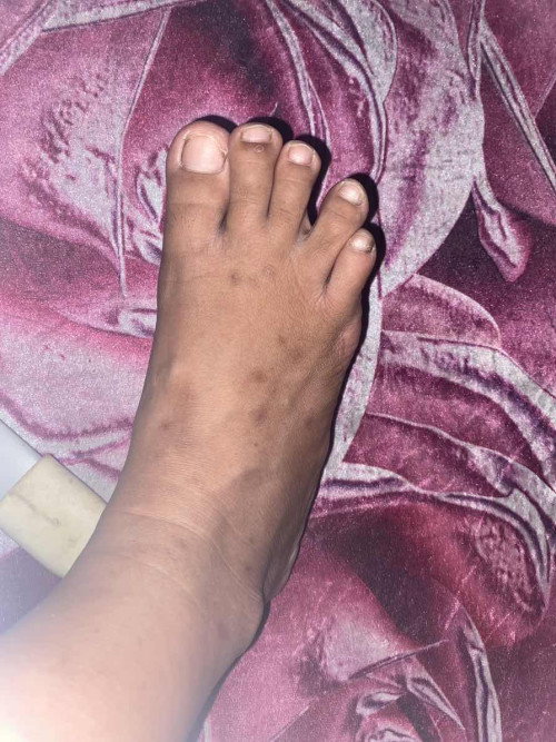 Gatal d kaki semenjak hamil