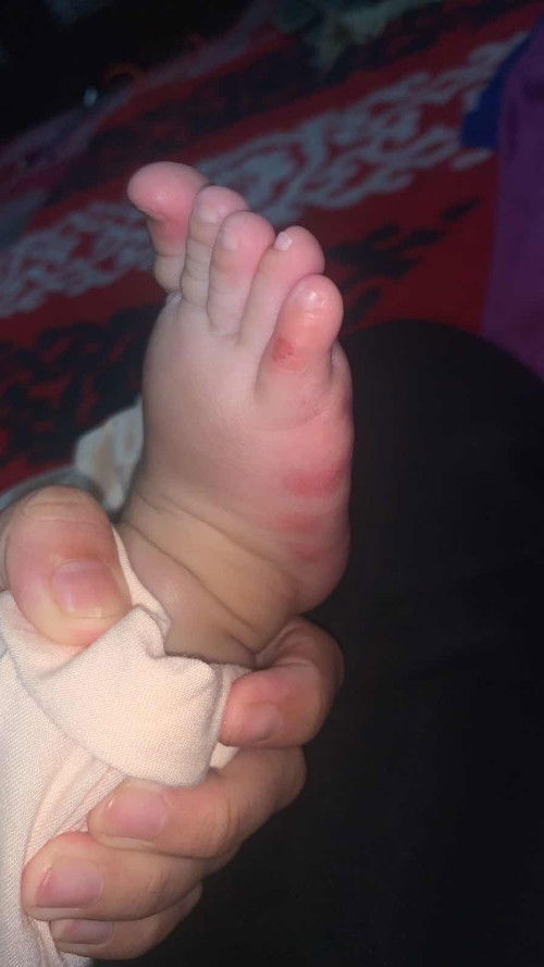 Penyakit kulit bayi umur 4 bulan