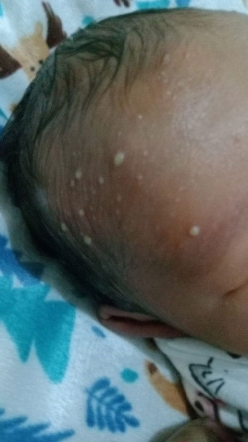 Melenting di kepala bayi