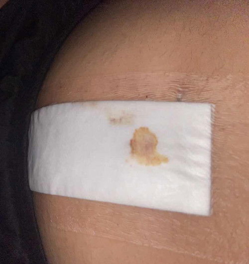 แผลผ่าคลอดมีเลือดซึม