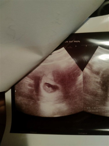 ขอความคิดเห็นจากแม่ๆค่ะ ซาวท้อง 8 วีค