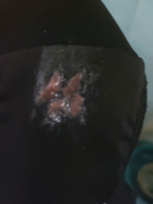 Discharge for 30weeks