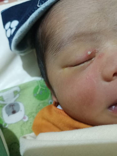 Bintik merah di kelopak mata bayi