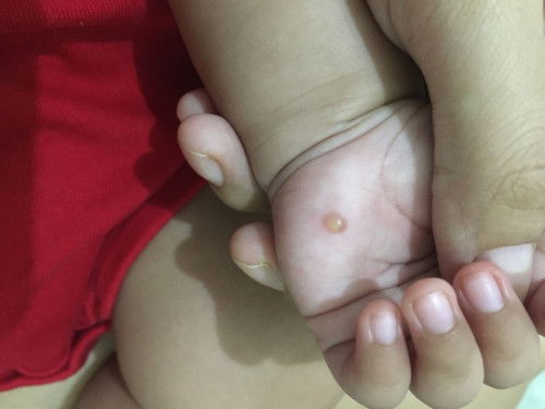 Bentol berair pada anak 2 bulan