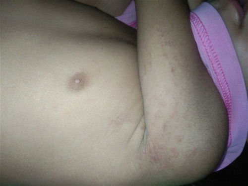 Rashes in a left under arm