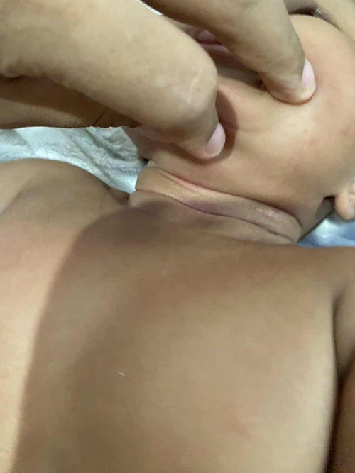 Garis leher sering merah kek luka