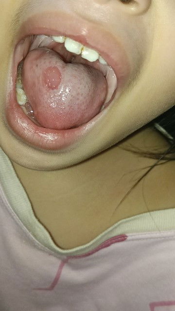 white spots sa dila ng anak ko / 3yo girl