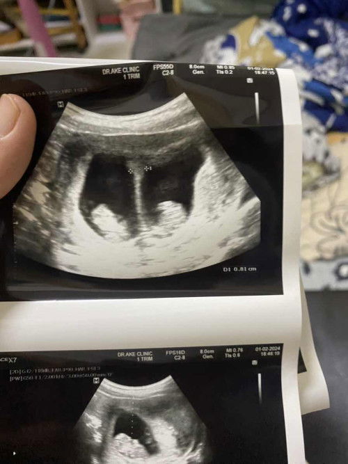 ตั้งครรภ์แฝดชายหญิง