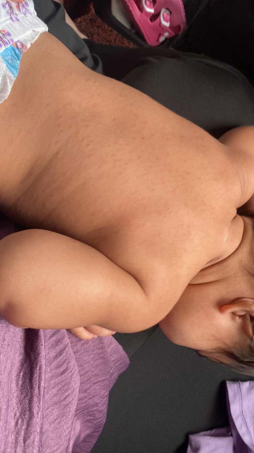 Bintik bintik satu badan