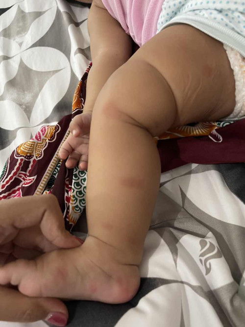 Kaki badan kemerahan