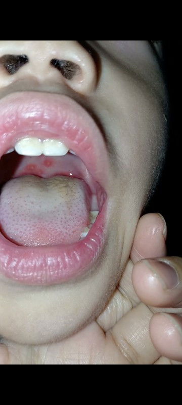 Butlig o singaw sa lalamunan