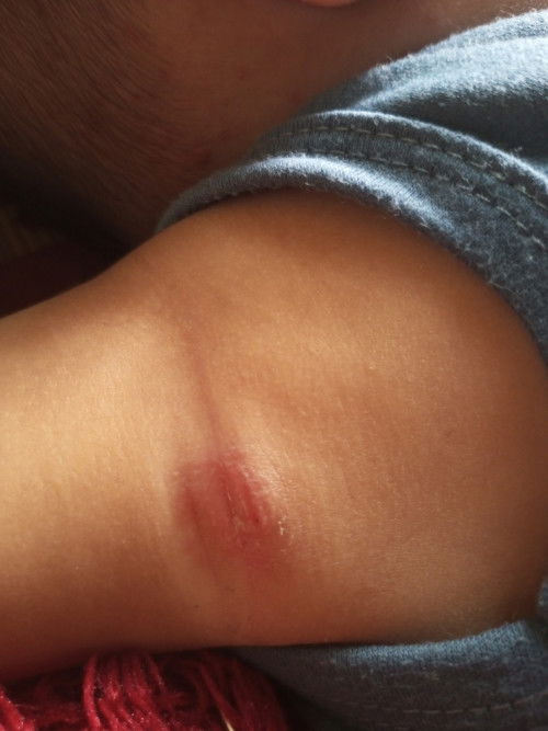 Lipatan leher dan lipatan lengan merah berair