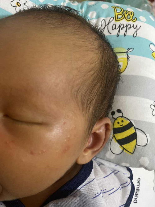 Bentol di area bawah mata