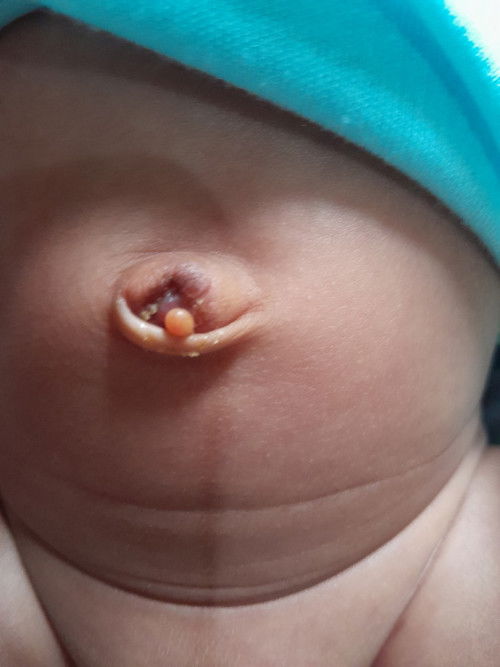 Granuloma umbilical
