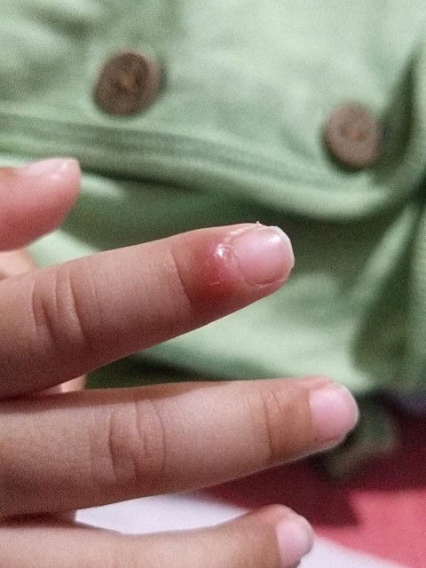Jari anak bayi 6 bulan agak bengkak agak keras