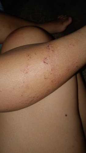 Dry Itchy Skin