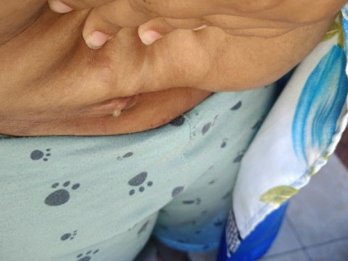 Bernanah dan benjolan di sebelah jaitan SC